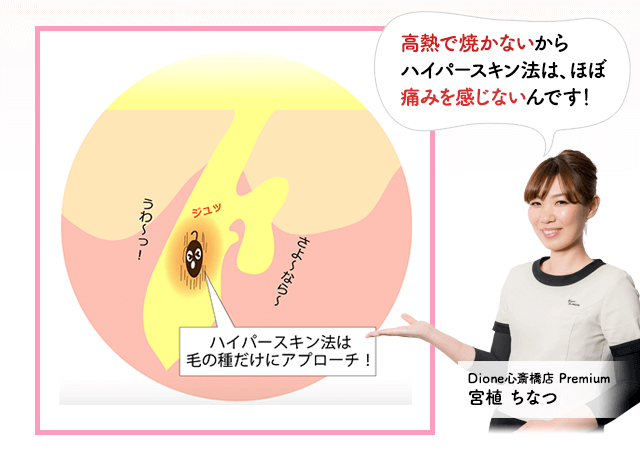 ハイパースキン法は毛の種だけにアプローチ。高熱で焼かないからハイパースキン法はほぼ痛みを感じないんです。ディオーネ心斎橋店宮植ちなつ